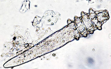 Demodex Folliculorum: Symptoms, Causes, Treatments, and More