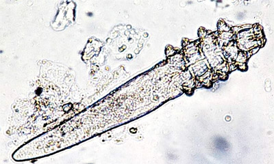 Demodex Folliculorum: Symptoms, Causes, Treatments, and More