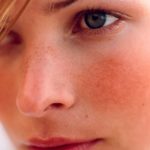 Rosacea: Treatment, types, causes, and symptoms rosacea-cure
