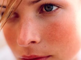 Rosacea: Treatment, types, causes, and symptoms rosacea-cure