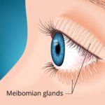 MGD-Meibomian Gland Dysfunction: Symptoms, Treatments and More mgd-meibomian-gland-dysfunction